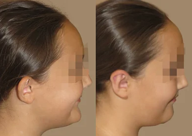 Ear Surgery (Otoplasty) - Ear Pinback on a Young Child - Otoplasty (ear pinback) on a young girl dissatisfied with the appearance of her ears. Procedure was performed under sedation and she back in school in 3 days