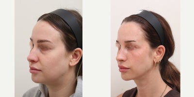 25-34 year old woman treated with AccuLift, Nonsurgical Facelift - Chief Complain: uneven face lines, hollowed under eyes, chubby cheeks, squared face shapeTreatment Plan: facial fat graft, under eye fat reposition, face liposuction ( cheeks, double chine, nasolabial folds) Outcome: - smooth V-lined face line - younger and refreshed look