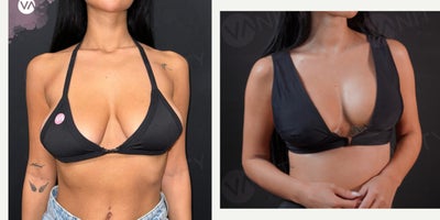18-24 year old woman treated with Breast Augmentation, Breast Implants - 18-24 year old woman treated with Breast Augmentation, Breast Implants