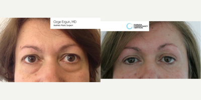45-54 year old woman treated with Eyelid Surgery - Eyelid Surgery