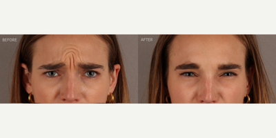 Upper Facial Botox (Forehead, 11's, Crows Feet) - 29-year-old female who requested conservative Botox treatment to address upper facial wrinkles of expression. Conservative dosing was used to preserve facial movement but reduce wrinkling. She is shown two weeks post-treatment.