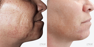 Face Age Spots Treatment using Chemical Peel - Solar lentigos, commonly called dark spots or age spots, are flat brown spots caused by sun exposure. They may be present all over the body surface, especially in the areas most exposed to UV rays. This condition can be effectively treated with chemical peels.