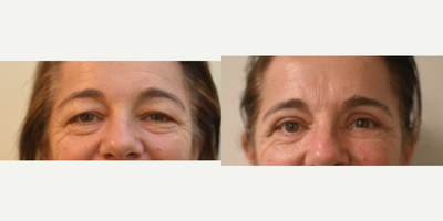 45-54 year old woman treated with Eyelid Surgery - Upper Eyelid Blepharoplasty
