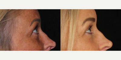 45-54 year old woman treated with Eyelid Surgery, Septoplasty - Upper blepharoplasty B&A with septoplasty.