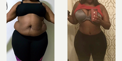 Tummy Tuck + Intense Lipo + Dominican Butt Lift (Dbl) - Tummy Tuck + Full body intense lipo removing 10 liters (10,000cc) of fat from the belly waist, flanks, armpits, upper and lower back and inner thighs lipo areas + 3,000 cc fat transferred to butt and hips performing a Dominican Butt Lift.