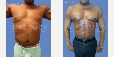 55-64 year old man treated with Liposuction - 50+ y/o male only 6 weeks s/p Vaser liposuction 360