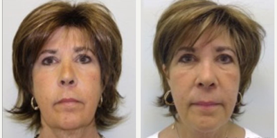 Woman treated with Evolve - Woman treated with Evolve.