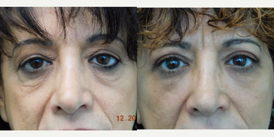 55-64 year old woman treated with Lower Lid Fat Transfer and Upper Blepharoplasty - This woman of Middle Eastern descent presented with the concerns of tired looking eyes. She did not like the heaviness above, nor the hollowness and depressions below. Exam revealed excess thin skin above each eye along with volume loss in the upper cheeks and lower eye rims. We agreed upon performing an upper blepharoplasty (eyelid lift) to remove the excess skin above, and fat transfer under the eyes and cheeks. Both procedures were performed on the same day in our Center under local anesthesia with mild oral sedation. Her results demonstrate much healthier and natural appearing eyes. This combination of procedures is very common, with only stitches being needed above the eyes and one below the belly button (to remove the fat for transfer).