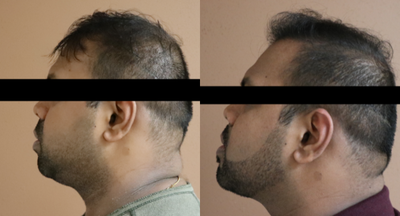 25-34 year old man treated with Buccal Fat Removal - This gentleman desired a stronger jawline and chin as well as treatment for excess fat of the midface and neck. He underwent chin augmentation with a silicone implant combined with buccal fat pad removal and submental liposuction (neck).