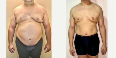 25-34 year old man treated with Gynecomastia Surgery, Male Tummy Tuck - 25-34 year old man treated with Gynecomastia Surgery, Male Tummy Tuck