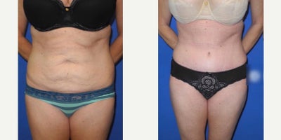 Woman treated with Tummy Tuck - Woman treated with Tummy Tuck