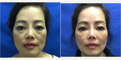 35-44 year old woman treated with Belotero - Asian woman with under eye circles, treated with syringe of Belotero in tear troughs. Belotero filled in her under-eye circles and created a smoother surface under her eyes to her cheeks.