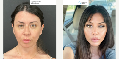 35-44 year old woman treated with Facelift, Rhinoplasty, Brow Lift - Facelift, Rhinoplasty, Brow Lift