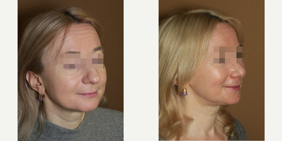 Woman treated with Rhinoplasty - Woman treated with Rhinoplasty