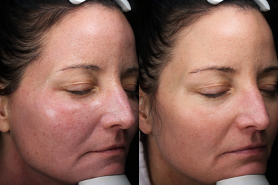 45-54 year old woman treated with Halo Laser - 48 year old female with BBL and HALO