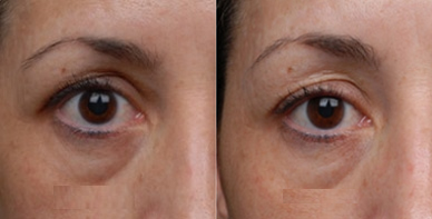 Woman treated with Pelleve - Woman treated with Pelleve