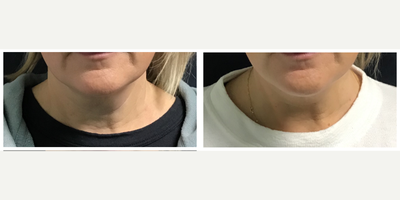 45-54 year old woman treated with Pelleve - Pelleve neck treatments