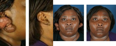 Keloid Removal Before & After - Keloid scar removal on the ear.