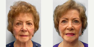 75 and up year old woman treated with Facelift - This woman in her mid-eighties had concerns about the laxity of her jowls. She had a facelift by Dr. Tucker seven years prior and chose to proceed with a second facelift. She has healed well, looks great and is shown before and after two months.