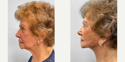 75 and up year old woman treated with Facelift - This woman in her mid-eighties had concerns about the laxity of her jowls. She had a facelift by Dr. Tucker seven years prior and chose to proceed with a second facelift. She has healed well, looks great and is shown before and after two months.