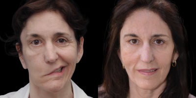 45-54 year old woman treated with Facial Reconstructive Surgery - Before & After Complex Facial Paralysis Surgery (Masseteric Transfer, Cross-Facial Graft & Gracilis Flap)