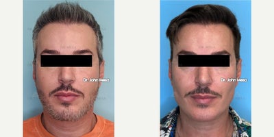 45-54 year old man treated with Dermal Fillers, Chin Filler, Buccal Fat Removal - 45-54 year old man treated with Buccal Fat Removal (Facial Masculinizationwith fillers) Cheekbone Fillers, Chin Filler