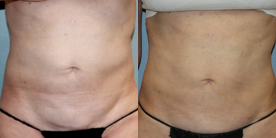 35-44 year old woman treated with UltraShape on the abdomen and flanks - This female patient had 3 UltraShape Power treatments on her abdomen and flanks. While she was already a very fit individual, she had some trouble areas she couldn't get rid of through diet and exercise.