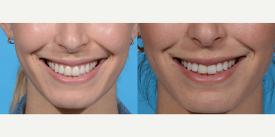 25-34 year old woman treated with Botox for Gummy Smile - Before and two weeks after Botox for gummy smile. Notice how her upper lip rolls inward before, and looks fuller in the after photo!