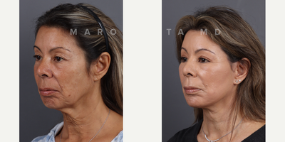 Woman treated with Dermabrasion, Chemical Peel - Facial rejuvenation with Dr James Marotta. Before and after journey. Dr. Marotta's expertise shines through in these great results, achieved through a combination of deep plane face and neck lift, upper blepharoplasty, perioral dermabrasion, and a chemical peel. Deep Plane Face and Neck Lift: Elevate your beauty to new heights as Dr. Marotta reshapes and rejuvenates facial contours by addressing deeper layers, tackling sagging skin and restoring youthful volume. Upper Blepharoplasty: Open your eyes to a brighter, more refreshed look! Dr. Marotta's precise upper blepharoplasty technique removes excess skin, revealing the true beauty of your gaze. Perioral Dermabrasion: Erase the traces of time around your mouth with perioral dermabrasion. Experience smoother, radiant skin as fine lines and wrinkles fade away. Chemical Peel Magic: Peel back the years with a chemical peel curated by Dr. Marotta. Unveil a radiant complexion, free from imperfections, as the outer layers of your skin are renewed.