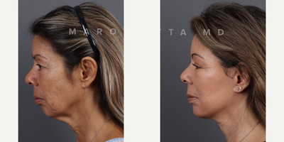 Woman treated with Dermabrasion, Chemical Peel - Facial rejuvenation with Dr James Marotta. Before and after journey. Dr. Marotta's expertise shines through in these great results, achieved through a combination of deep plane face and neck lift, upper blepharoplasty, perioral dermabrasion, and a chemical peel. Deep Plane Face and Neck Lift: Elevate your beauty to new heights as Dr. Marotta reshapes and rejuvenates facial contours by addressing deeper layers, tackling sagging skin and restoring youthful volume. Upper Blepharoplasty: Open your eyes to a brighter, more refreshed look! Dr. Marotta's precise upper blepharoplasty technique removes excess skin, revealing the true beauty of your gaze. Perioral Dermabrasion: Erase the traces of time around your mouth with perioral dermabrasion. Experience smoother, radiant skin as fine lines and wrinkles fade away. Chemical Peel Magic: Peel back the years with a chemical peel curated by Dr. Marotta. Unveil a radiant complexion, free from imperfections, as the outer layers of your skin are renewed.