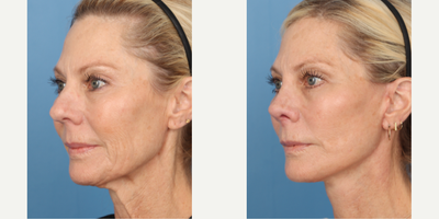 55-64 year old woman treated with Facelift, Rhinoplasty - Facelift and Rhinoplasty 1 month post op