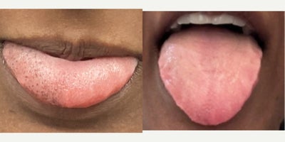 35-44 year old woman treated with Laser Peel - 36 year old woman treated Ruby Laser treatment for tongue pigmentation. Successful results after 4 weeks. Dark spots on the tongue are not visible.