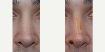 Non-Surgical Rhinoplasty Before & After: Addressed Nostril Asymmetry and an Overly Pointy Nasal Tip with Permanent Microdroplet  - Our patient came to see us from afar, with dissatisfaction with his nasal appearance after previous rhinoplasty surgery was performed elsewhere. Unfortunately, his original surgeon left him with many stigmata of previous rhinoplasty surgery: A crooked appearance, nostril asymmetry, and overly pointy nasal tip appearance, and a non-masculine curve of his bridge on profile. You can see after his permanent non-surgical revision rhinoplasty treatment that he has a much more natural appearing nasal appearance. And this was all performed without the inconvenience, uncertainty, downtime, and expense associated with revision rhinoplasty surgery. In fact, I believe this represents an excellent candidate for permanent non-surgical nose job treatments. In general, our patients will require two to three treatments to achieve a permanent, natural looking, and desired result. Additionally, microdroplet Silikon-1000 injections on never associated with necrosis, embolus, blindness, stroke, infection, or biofilm. These permanent non-surgical revision rhinoplasty treatments boast a 60-year history of precision permanence and safety, and I am grateful for my rhinoplasty teacher for teaching this art to me, 28 years ago.