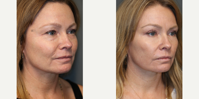 Upper and Lower Eyelid Surgery - Upper and lower eyelid surgery with laser.