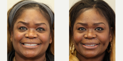 45-54 year old woman treated with Dimpleplasty - 48 year old treated with dimple creation surgery