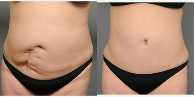 45-54 year old woman treated with Scar Removal - This is a 45 year old female patient with a tummy scar that I was able to completely remove using tummy tuck techniques.