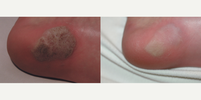Laser wart removal with the Vbeam laser.  Before and after laser wart removal. - Patient was a young man that played soccer and he could not play because of this gigantic plantar's wart on his foot.  3-4 Vbeam laser treatments later, his wart is gone!