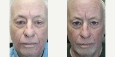 65-74 year old man treated with Ptosis Repair - 65-74 year old man treated with Ptosis Repair