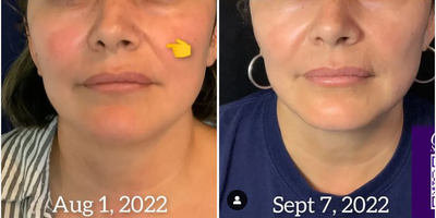 35-44 year old woman treated with Microneedling RF - My early 40-year-old patient wanted tighter skin around the mouth and nose (nasolabial lines). You can see the changes in her overall skin, loose skin, as well as her jawline. Already seeing results in 5 weeks with RF Microneedling and Xeomin! RF (radiofrequency) Microneedling is clinically proven to safely and effectively address a number of issues, including wrinkles, redness, acne scars, and large pores, and improve the overall look and tone of the skin. Sylfirm X is the latest generation RF energy microneedling device that is FDA approved and clinically proven to safely and effectively address skin concerns. Sylfirm is also the only RF microneedling device approved to safely treat neovascular concerns, including hard-to-treat conditions like rosacea and melasma. Sylfirm X delivers RF energy beneath the skin through tiny needles that are applied to the skin. The RF energy greatly boosts the production of collagen, which is the main building block for stronger, healthier, and more youthful skin. This repairs, smooths and tightens your skin, causing it to look younger and more radiant, and healing or greatly reducing scarring, pigmentation concerns, and many other skin issues.