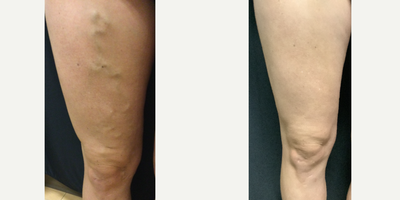 Sclerotherapy & RFA - Pre vs Post treatment of sclerotherapy & vein ablation
