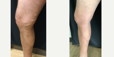 Leg Sclerotherapy & RFA - Pre vs Post treatment of sclerotherapy & vein ablation