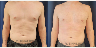 Man treated with Gynecomastia Surgery - Man treated with Gynecomastia Surgery