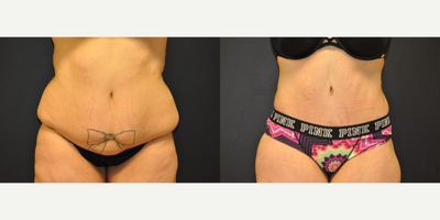 32 year old woman treated with Tummy Tuck Revision - 32 year old woman had a tummy tuck 8 years ago by a different surgeon.2 months after Secondary Extended Tummy Tuck with Pubic Lift, Liposuction of Abdomen, Flanks & Lower Back by Dr. Steely.
