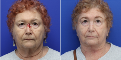 74 year old woman reconstructed following Mohs surgery for excision of skin cancer of the nose. - 74 year old woman underwent Mohs Surgery by Dermatology and came to Dr. Depew for reconstruction. A skin graft was used from her neck to reconstruct her nose, improving the appearance of her neck.
