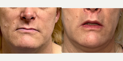 45-54 year old woman treated with Forehead Reduction, Brow Lift, Septoplasty, Rhinoplasty, Lip Lift, Lip Surgery, Adam's Apple R - This is a lady who underwent forehead feminization, septorhinoplasty, lip lift with augmentation, and chin feminization.