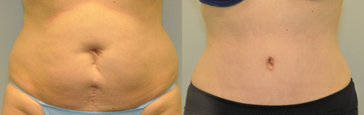 50 year old woman treated with Drainless Tummy Tuck - 50 year old female shown 2 months following a Drainless Tummy Tuck and SafeLipo of the flanks.
