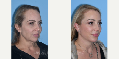 46 year old woman treated with Forehead Reduction - 46 year old woman treated with Chin Implant, Deep Plane Facelift with submandibular gland reduction, Neck Lift, Forehead Reduction, Brow Lift, baby laryngeal setback, and skin pinch.