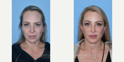 46 year old woman treated with Forehead Reduction - 46 year old woman treated with Chin Implant, Deep Plane Facelift with submandibular gland reduction, Neck Lift, Forehead Reduction, Brow Lift, baby laryngeal setback, and skin pinch.