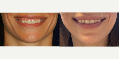 25-34 year old woman treated with Botox for Gummy Smile - 34 year old woman treated with Botox and a Lip Flip for Gummy Smile.