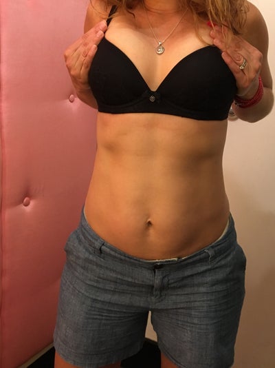 32DDD to 32B - Jacqueline Anne Luong, MD - Review - RealSelf